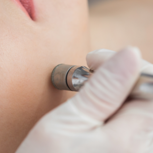 Peeling de Diamante (50min)